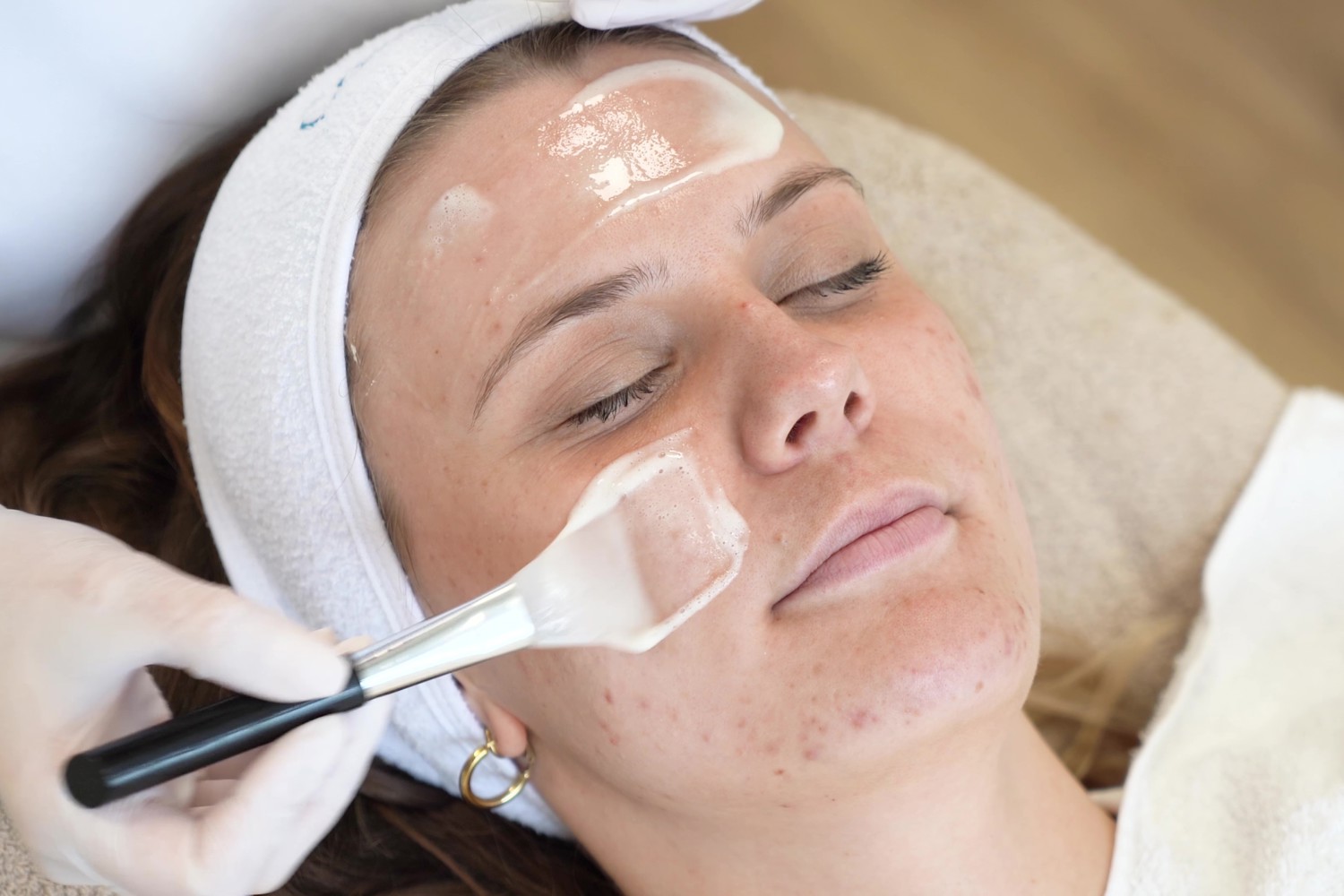 Acnepeeling En Microneedling