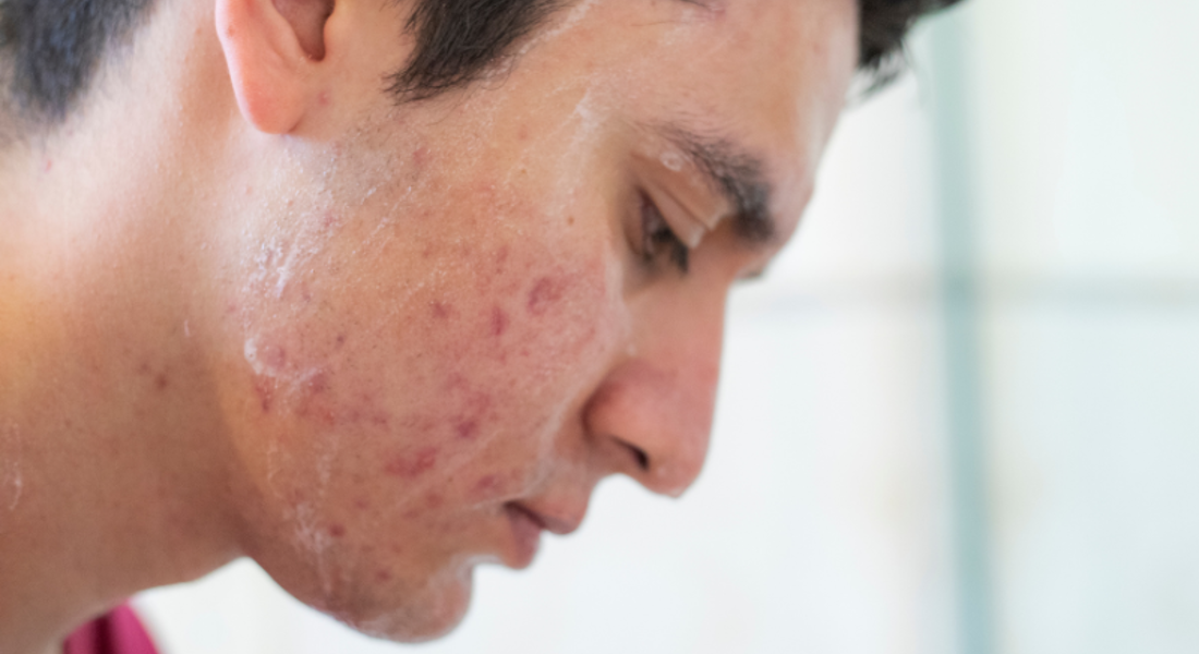 Acne Bij Mannen Oorzaken, Behandeling En Preventie