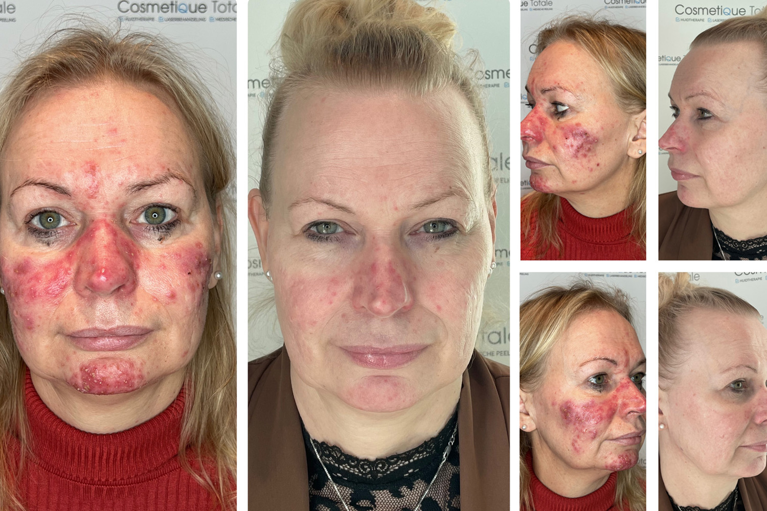 Resultaat Rosacea Julie Van Oord INTERN ONLY 1 3 2023 B