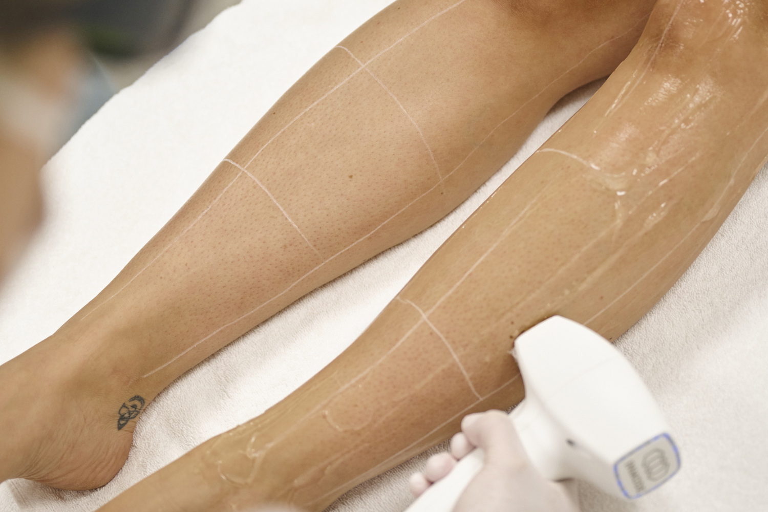 Laserontharing Strawberry Legs