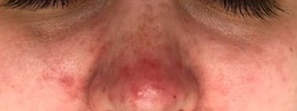 Rosacea Resultaat Voor