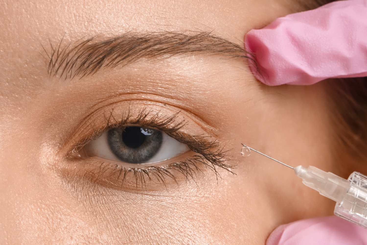 traitements par fillers pour réduire les poches sous les yeux