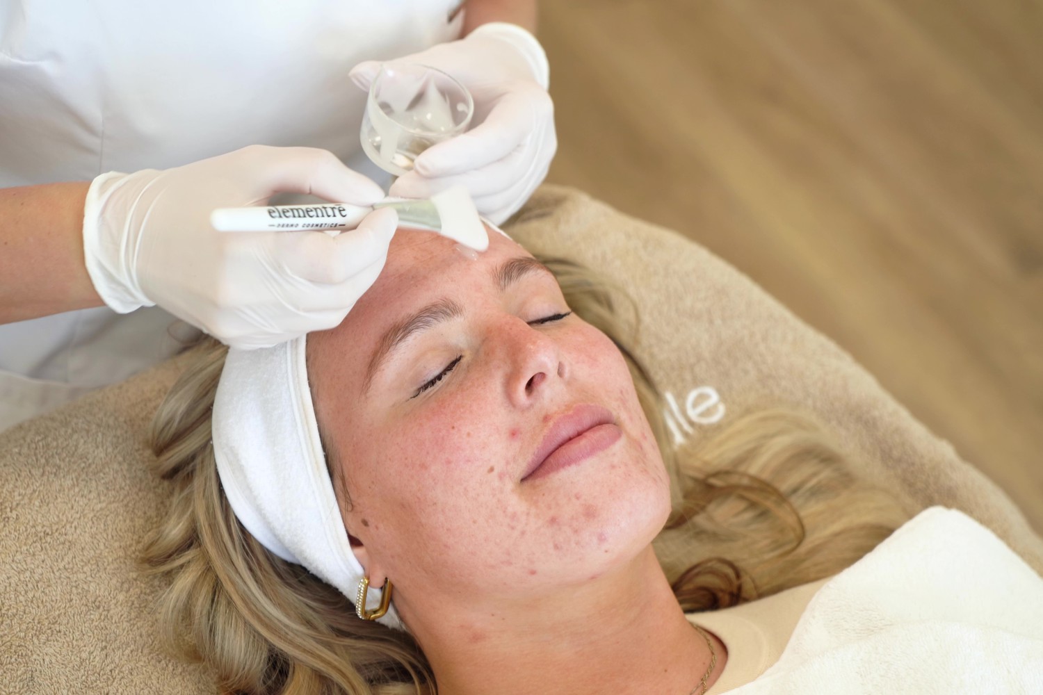 Meer Weten Over Het Behandelen Van Acne Peeling