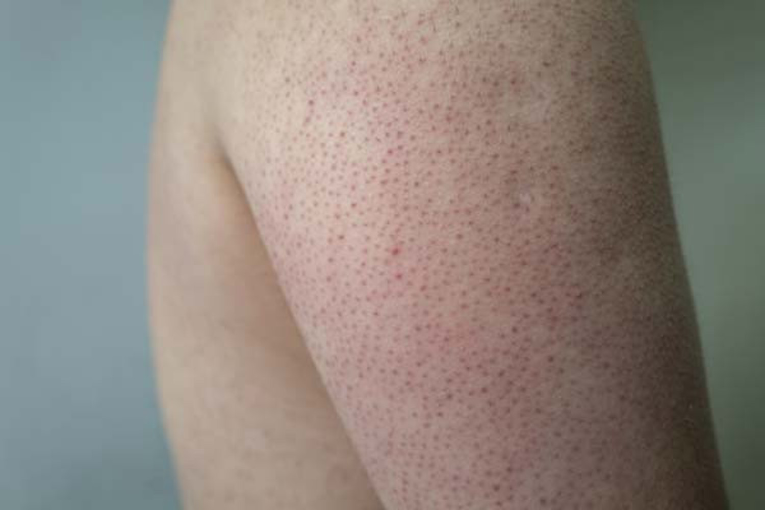 Keratosis Pilaris