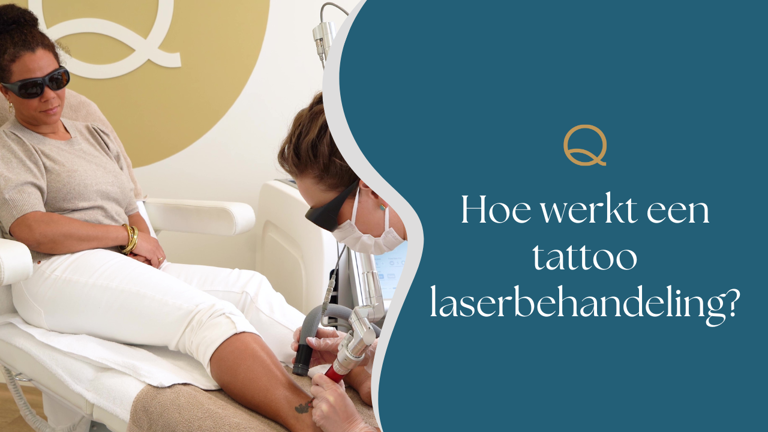 Hoe Werkt Een Tattoo Laserbehandeling