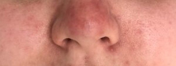 Rosacea Resultaat Na