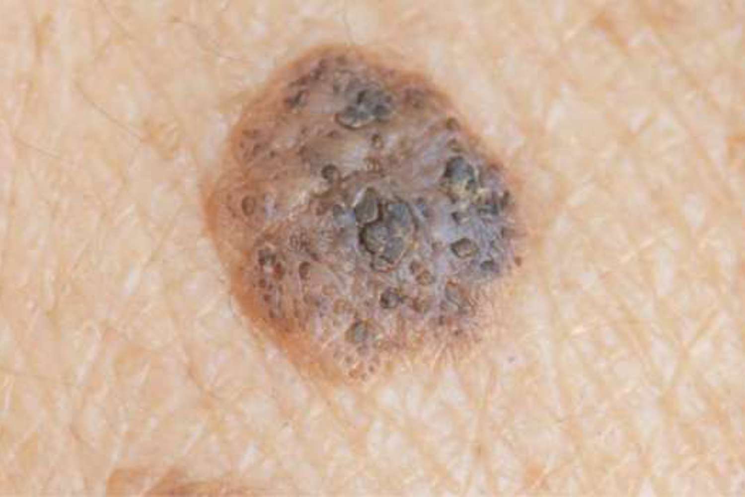 Seborrheic Keratoses