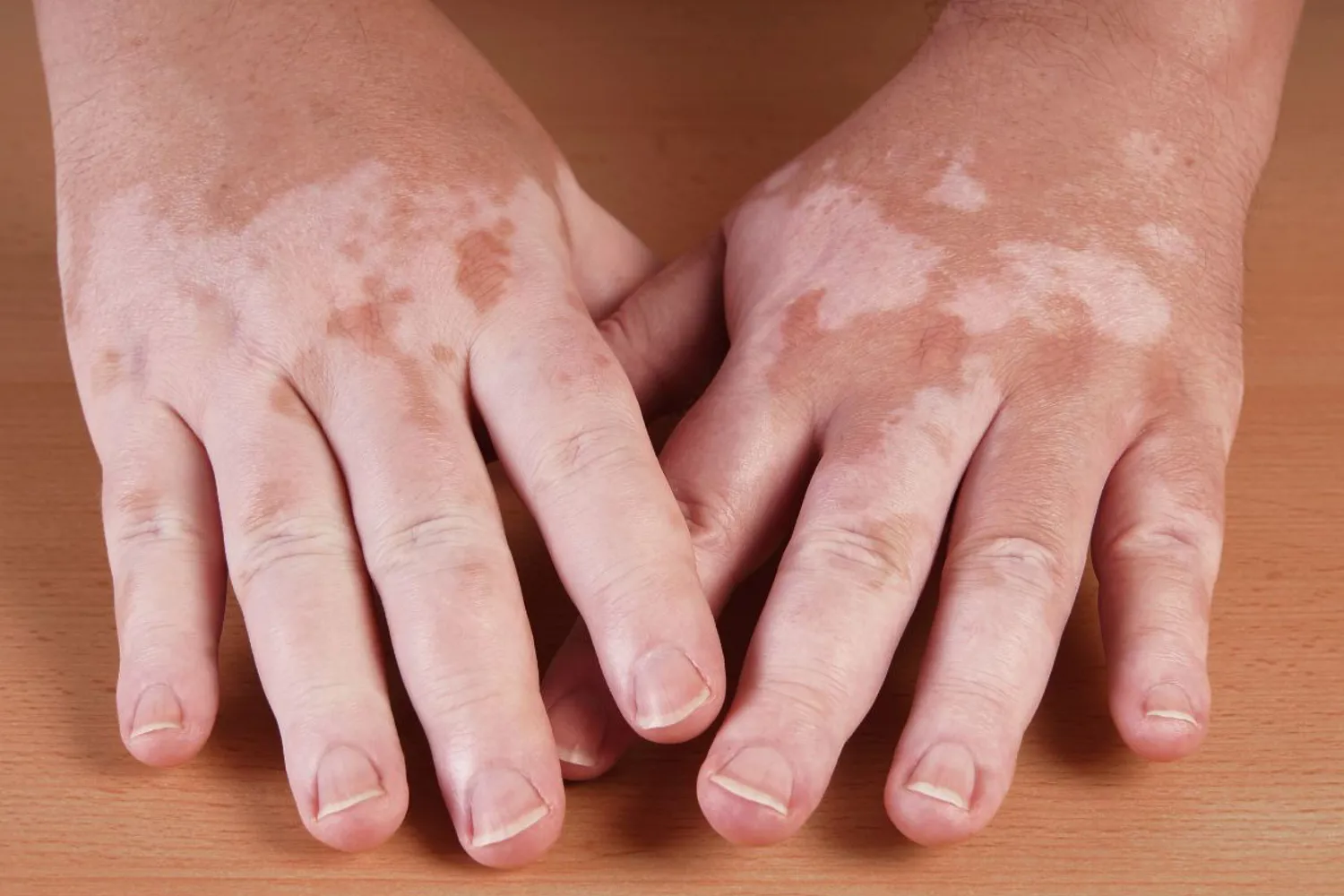 Vitiligo