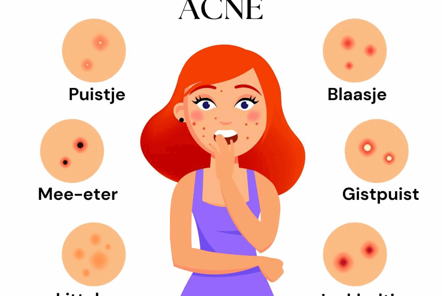 Wat is acne?