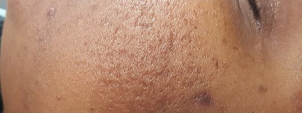 Résultat Cicatrices D'acne 12