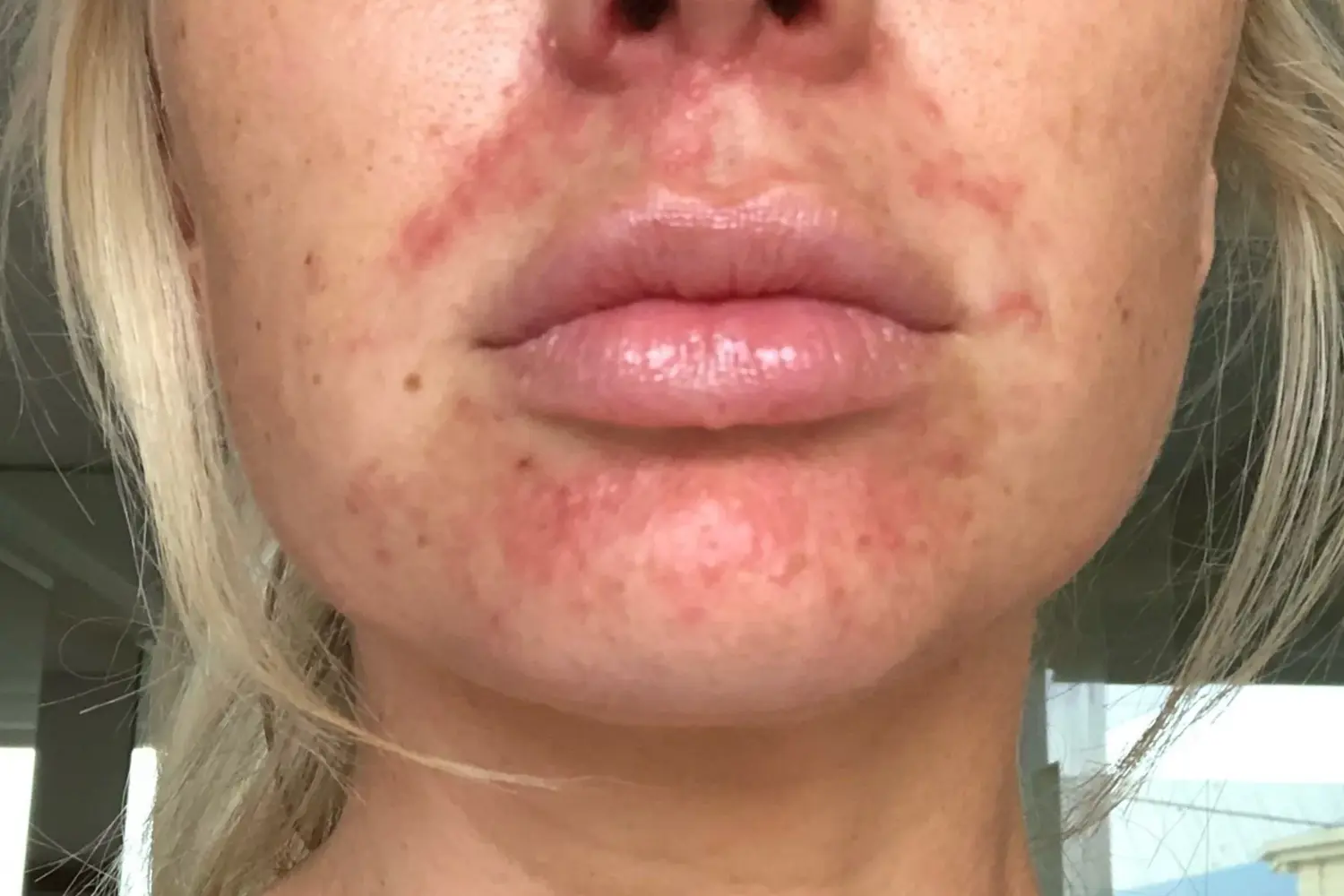 Perioral Dermatitis