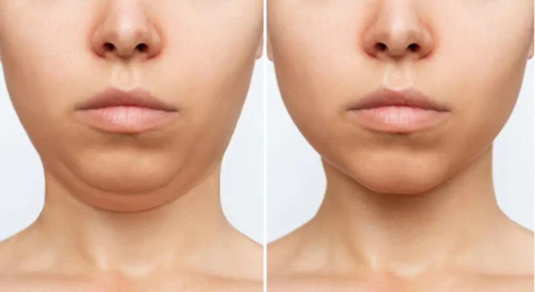 Face Yoga Facelift