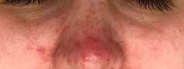 Ergebnis Bei Rosacea Nach