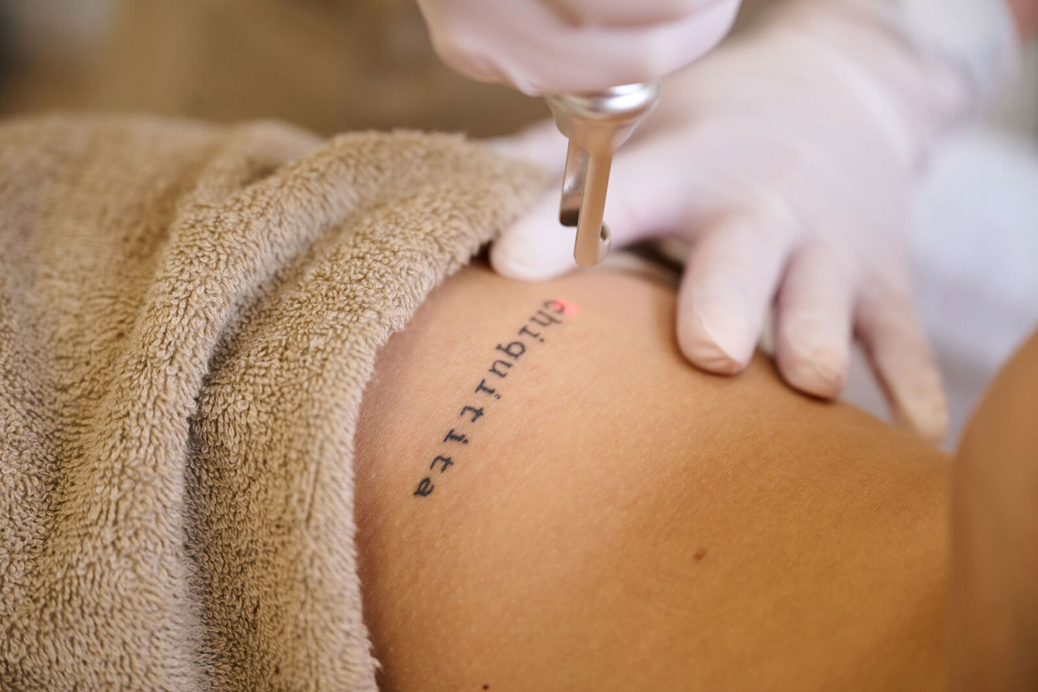 Tatoeage Verwijderen Bij Cosmetique Totale