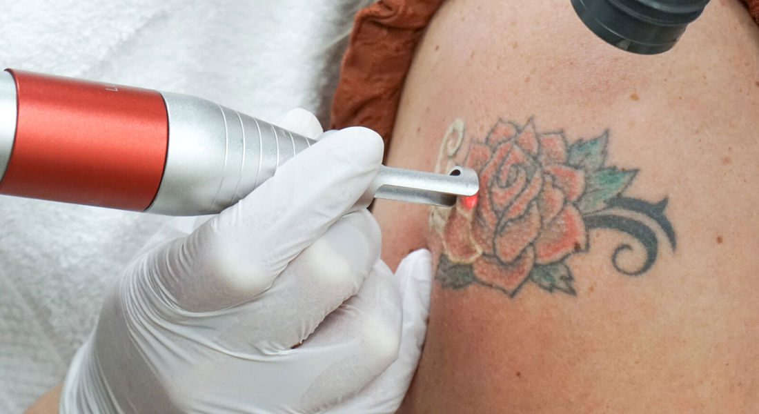 Gekleurde Tattoos Verwijderen, Kan Dat