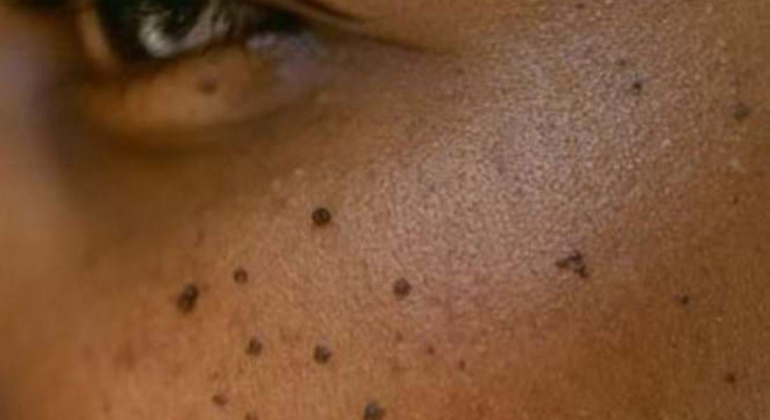 Points noirs visage : les faire disparaître grâce à la médecine