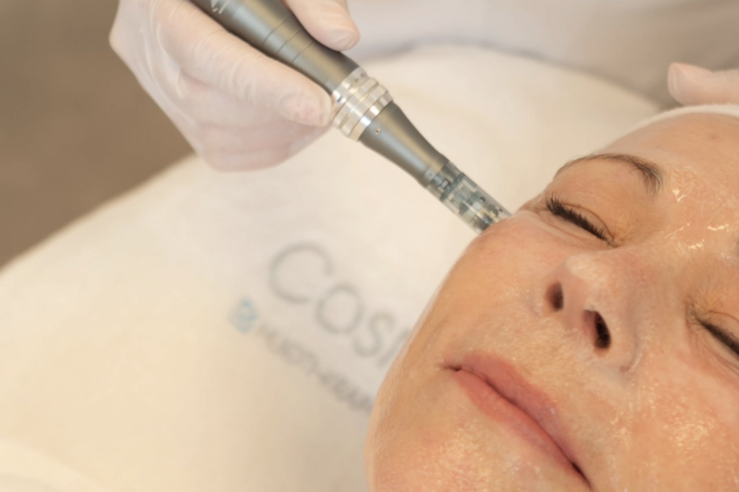 Microneedling (1)