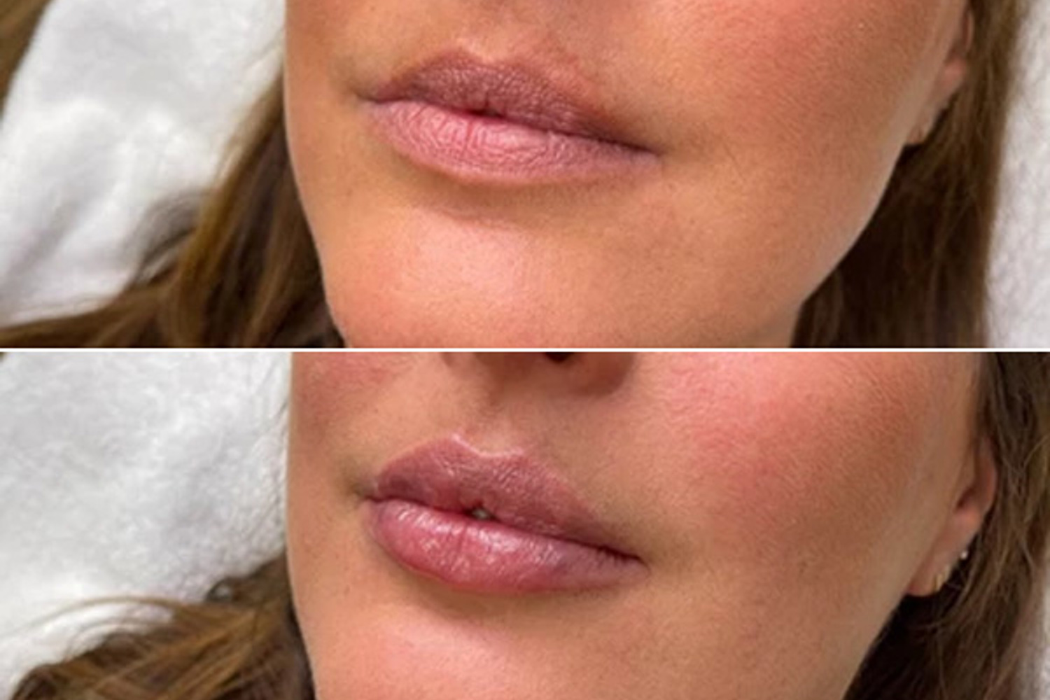 Resultaat Lipfillers