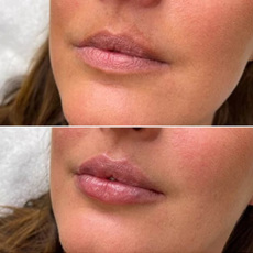 Resultaat Lipfillers