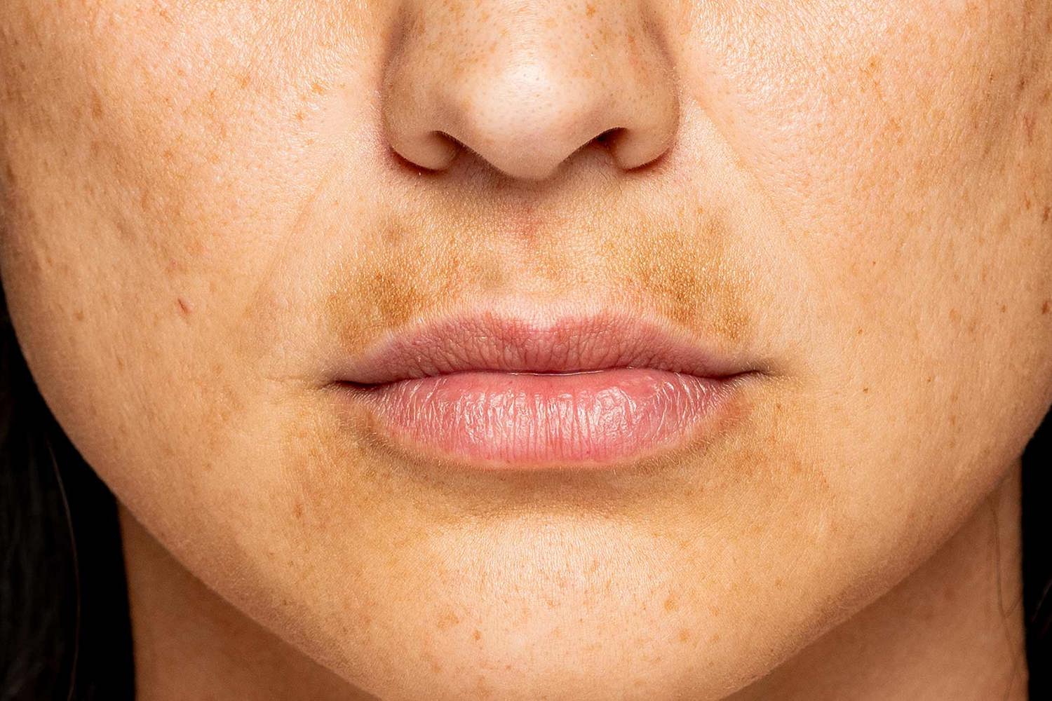 Melasma Snor