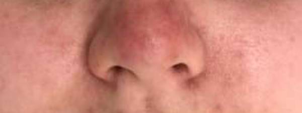 Ergebnis Bei Rosacea