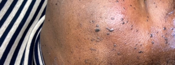 Coagulatie Dermatosis Papulosis Nigra 2X