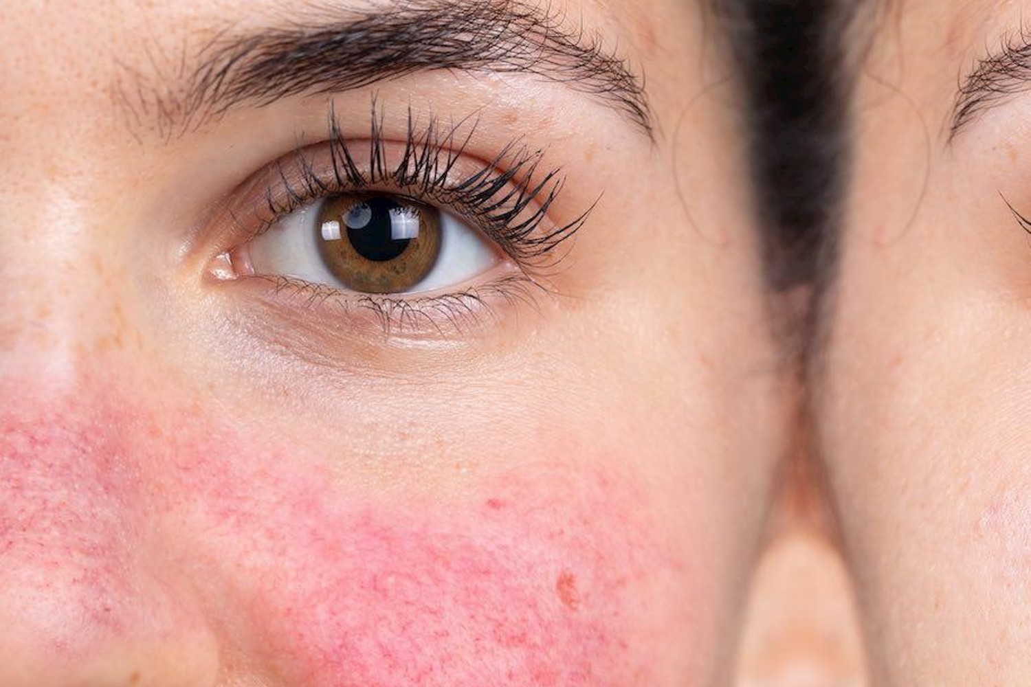 Rosacea