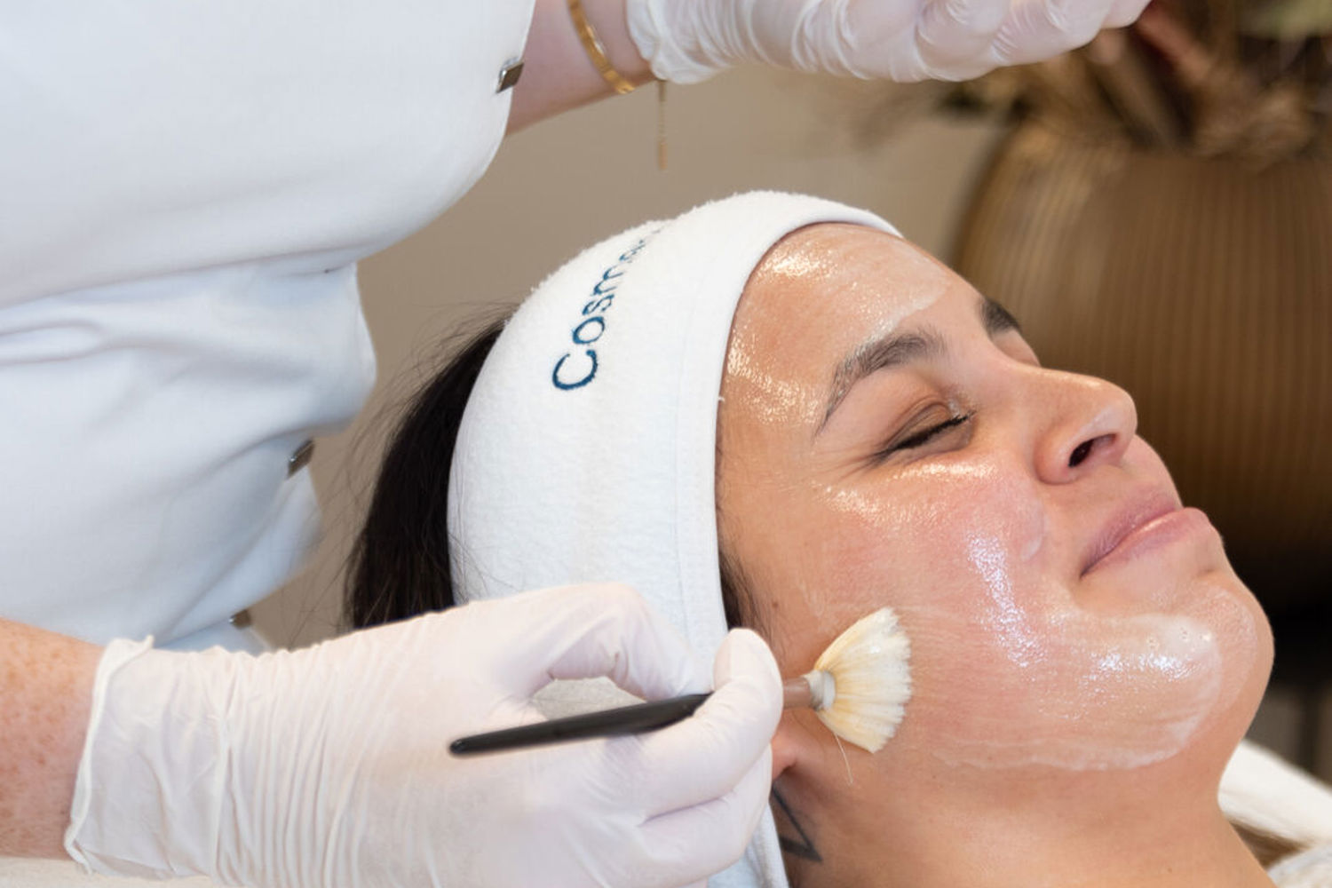 Chemische Peelings Bij Melasma